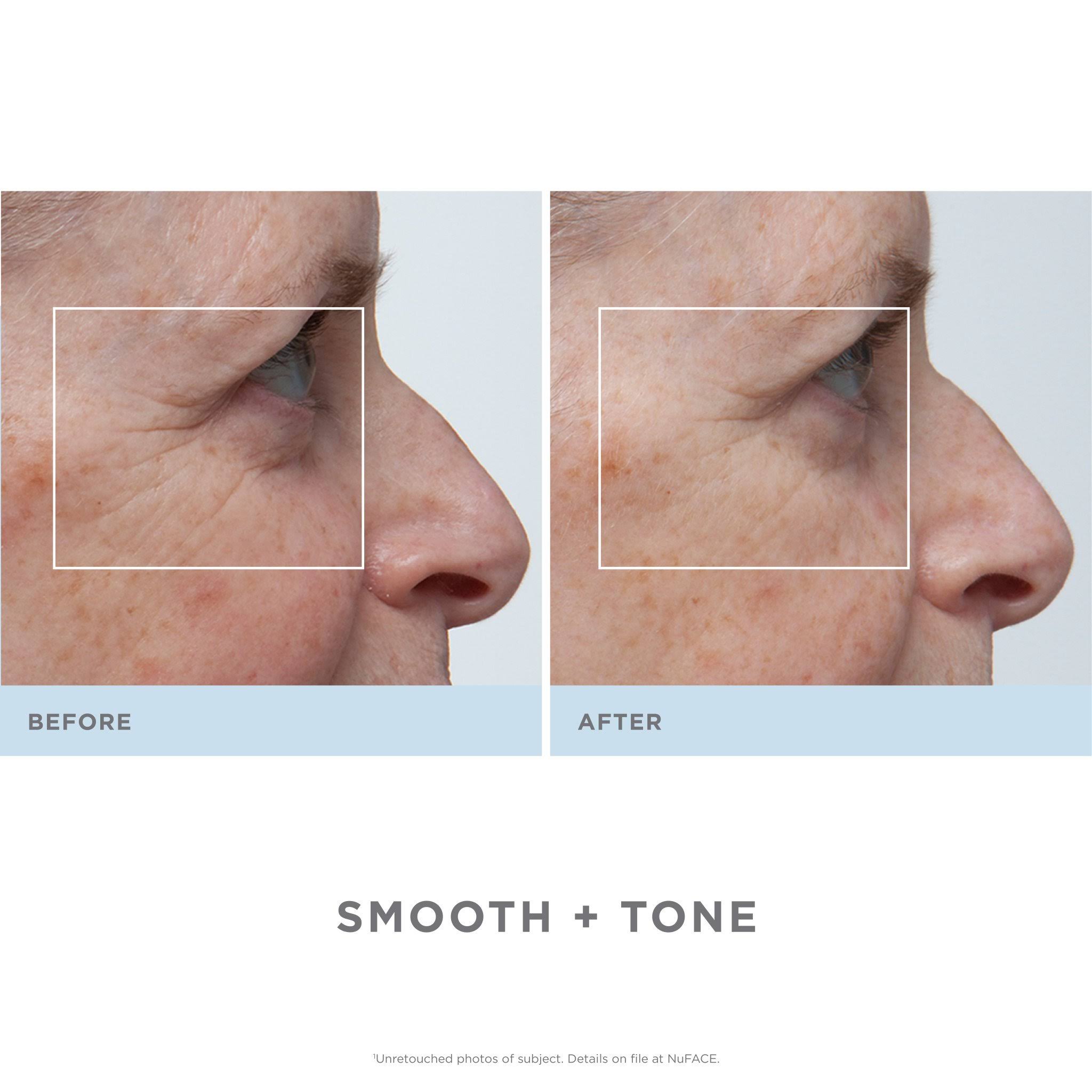 White Trinity Facial Trainer Kit with Wrinkle Reducer Attachment L460